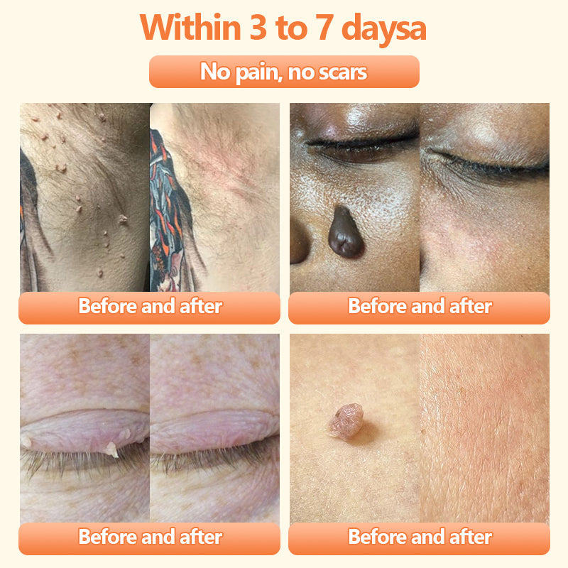 Turonuโข Bee Venom Treatment Cream for Scar Removal, Warts, Skin Tags, Tinea ๐