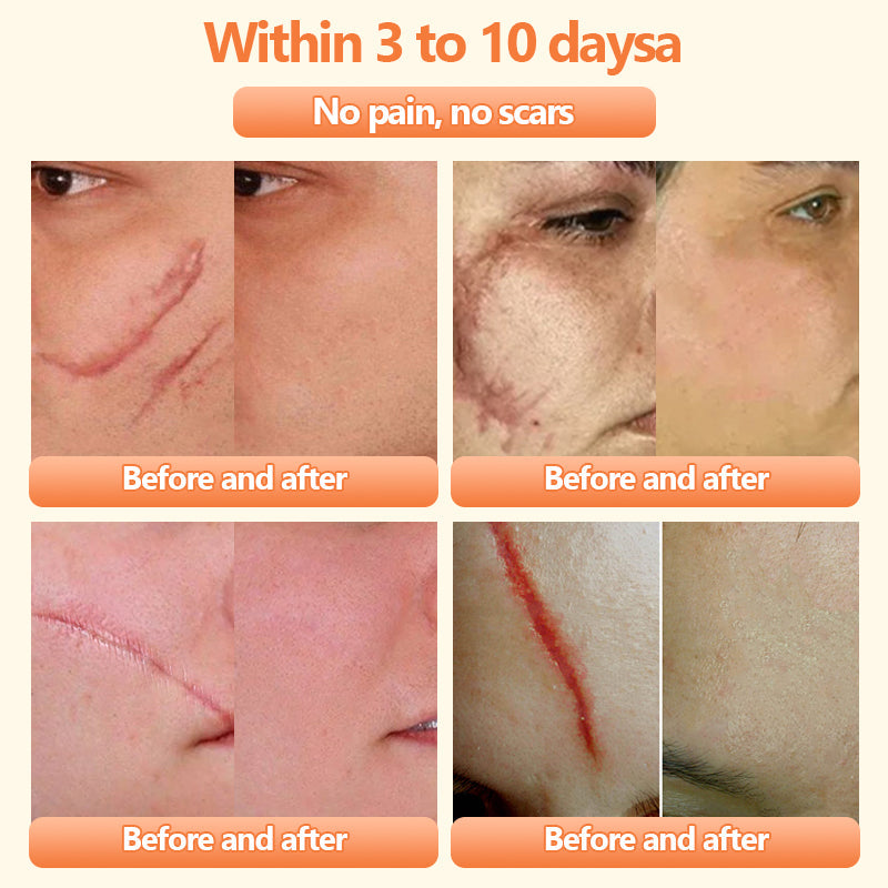 Turonuโข Bee Venom Treatment Cream for Scar Removal, Warts, Skin Tags, Tinea ๐