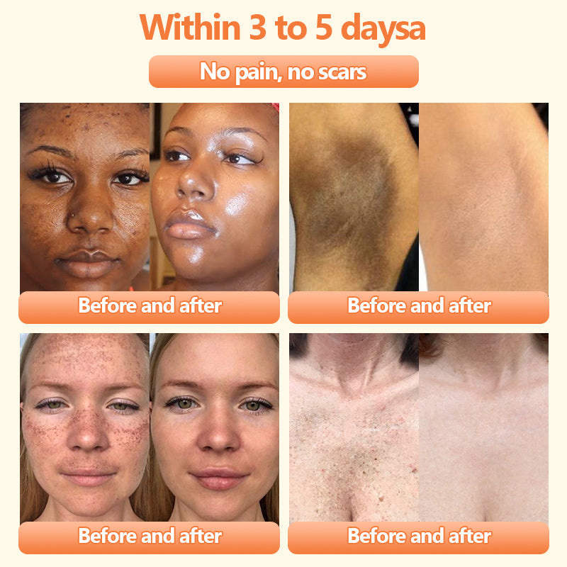 Turonuโข Bee Venom Treatment Cream for Scar Removal, Warts, Skin Tags, Tinea ๐
