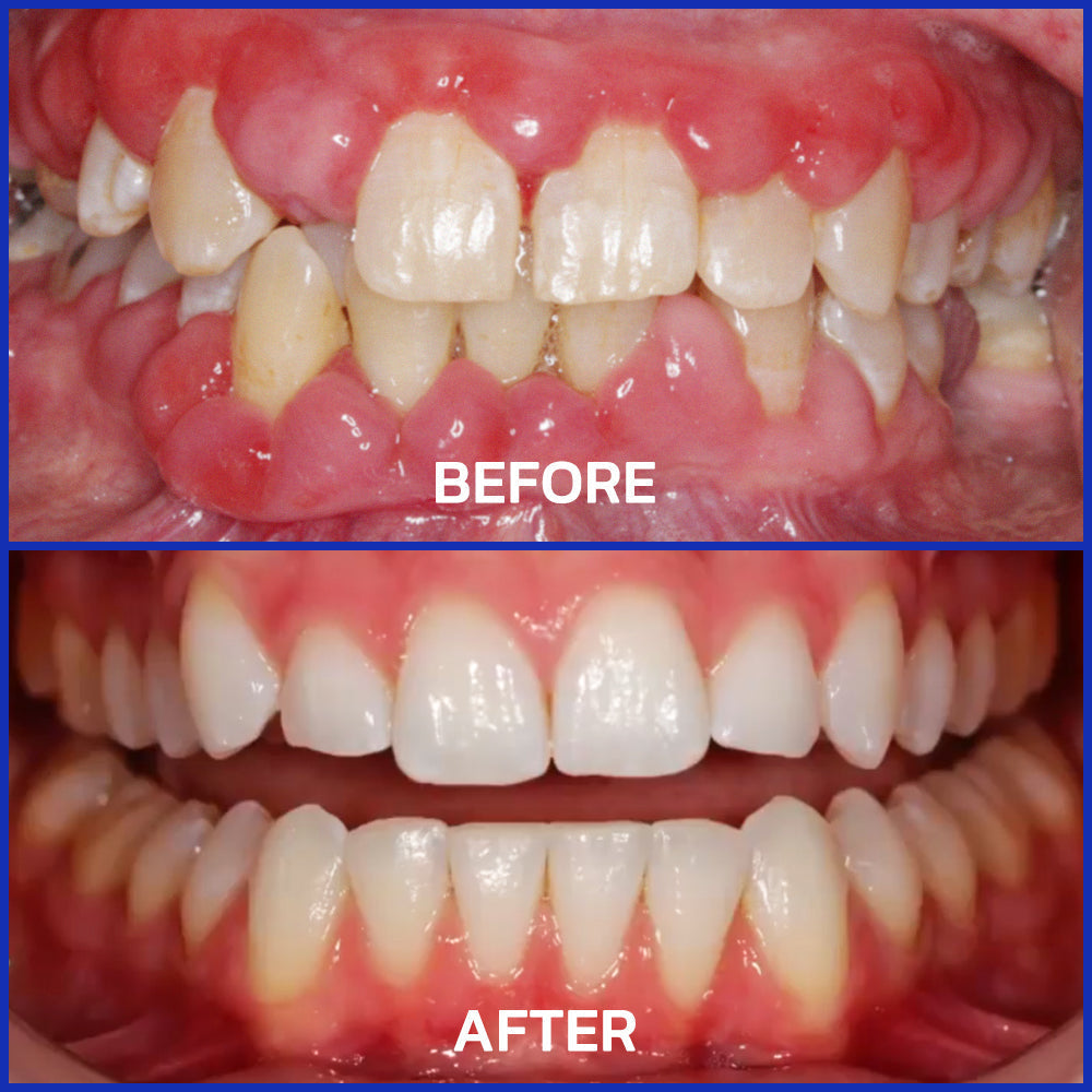 🏆 TLOPA™ Focussmile Bee Venom Treatment Oral Powder 🦷(🇦🇺ADA Recommended)