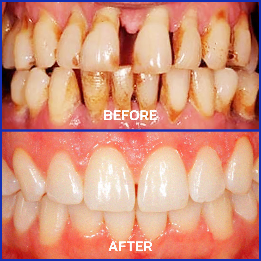 🏆 TLOPA™ Focussmile Bee Venom Treatment Oral Powder 🦷(🇦🇺ADA Recommended)