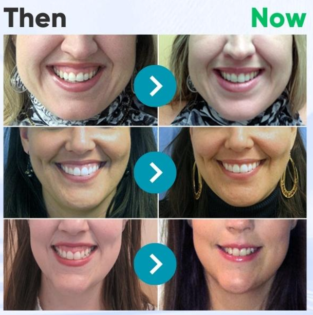 🏆 TLOPA™ Focussmile Bee Venom Treatment Oral Powder 🦷(🇦🇺ADA Recommended)