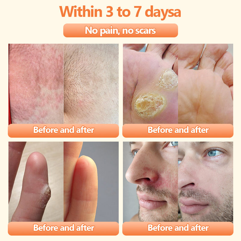 Turonuโข Bee Venom Treatment Cream for Scar Removal, Warts, Skin Tags, Tinea ๐